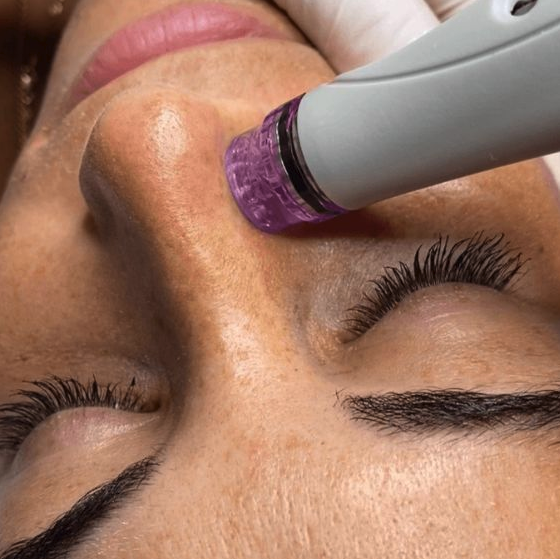 Close-up of a facial treatment targeting acne-prone skin with a professional device.