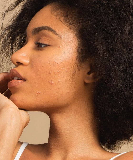 Woman with acne-prone skin, close-up of facial skin issues.