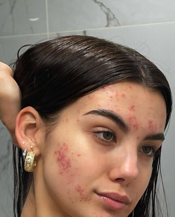 The best acne treatment facial