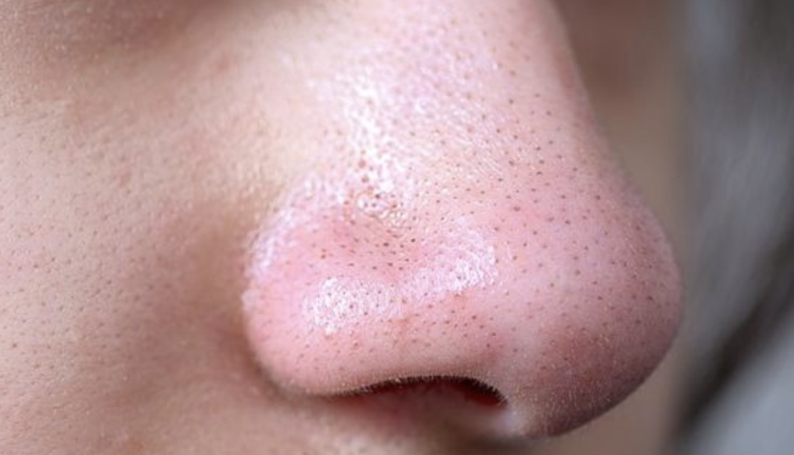 How to Minimise Sebaceous Filaments with