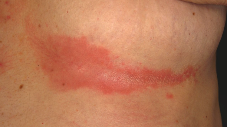 Best Soap for Intertrigo Skin Rash: Causes & Treatment - Natalie O'Neill