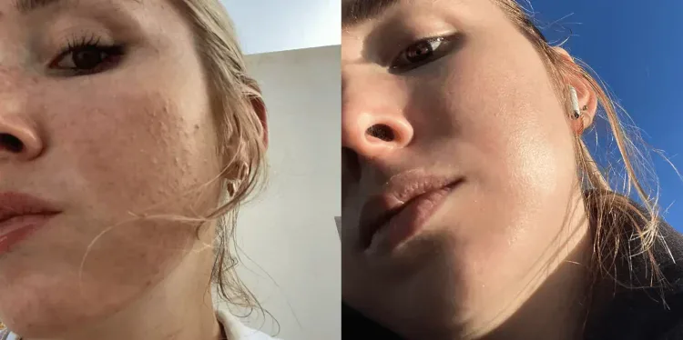 Side-by-side comparison of skin improvement showing clear skin results.