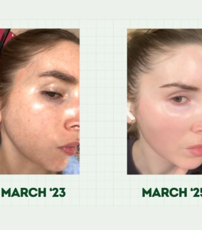 Can I Use Azelaic Acid With a Retinoid?